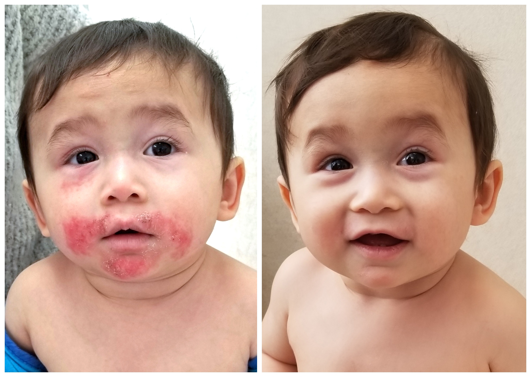 Atopic eczema is like an ‘asthma of the skin’ Hayti News, Videos and Podcasts from Black