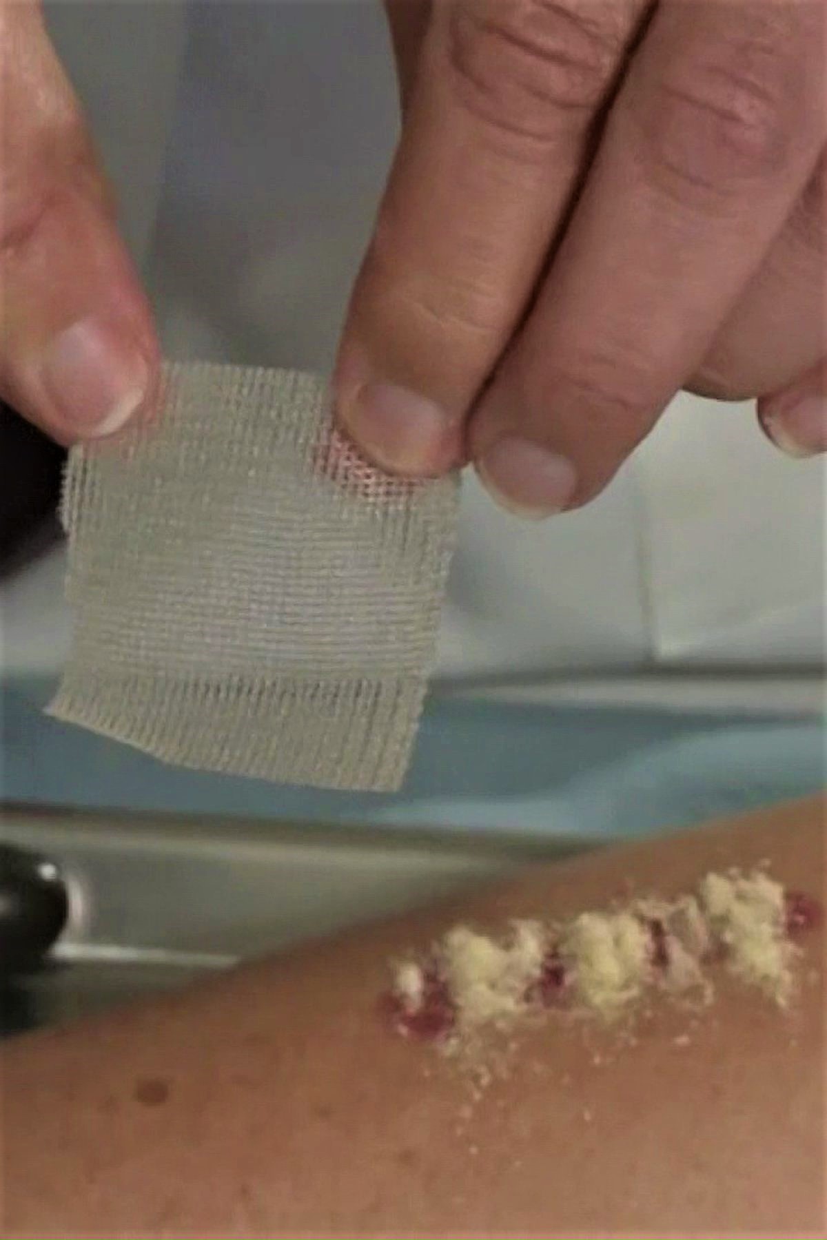 Applying antibiotic powder on fresh wounds to aid healing crude, can